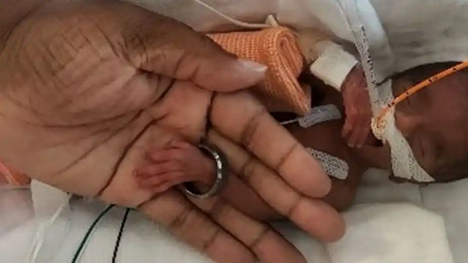 La milagrosa recuperación de la bebé que nació pesando 370 gramos