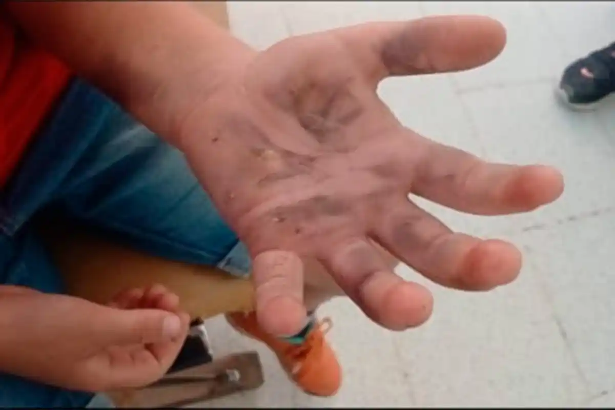 El nene sufrió quemaduras en su mano