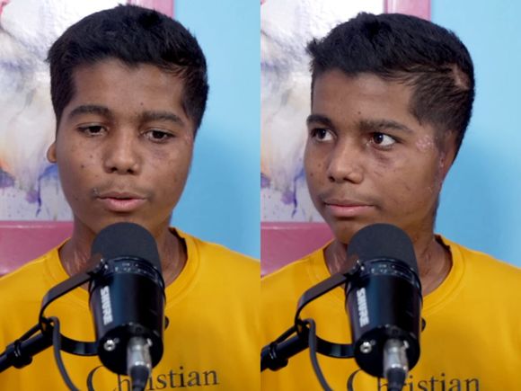 LA HORRIBLE historia del venezolano Greiber Berrío: víctima del ataque de 9 perros en Bogotá