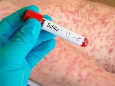 La sífilis registra su mayor número de casos desde que existen registros oficiales en la Argentina