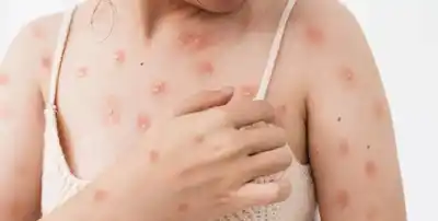 Viruela del Mono: qué es, cuáles son los síntomas y cómo se contagia