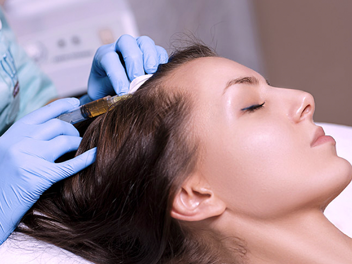 Mesoterapia capilar para frenar la caída del cabello   