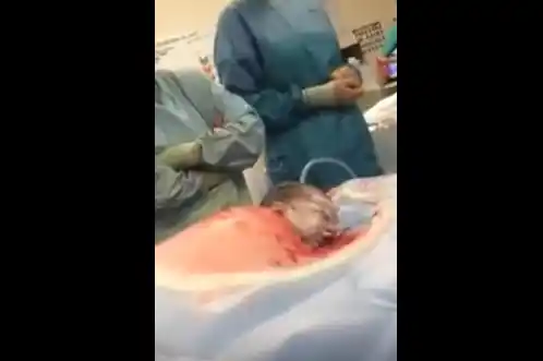 Video muestra el nacimiento de un bebé por cesárea "natural"