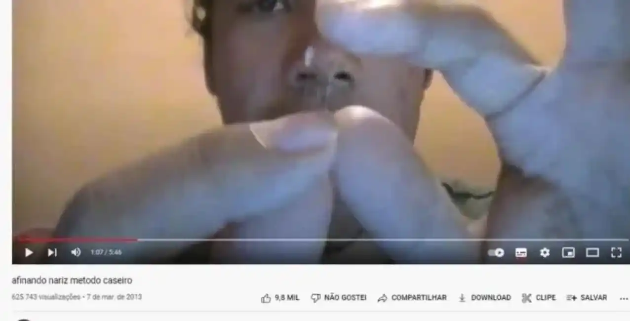 Brasil: un hombre se operó a sí mismo la nariz tras ver un tutorial de Internet y terminó hospitalizado