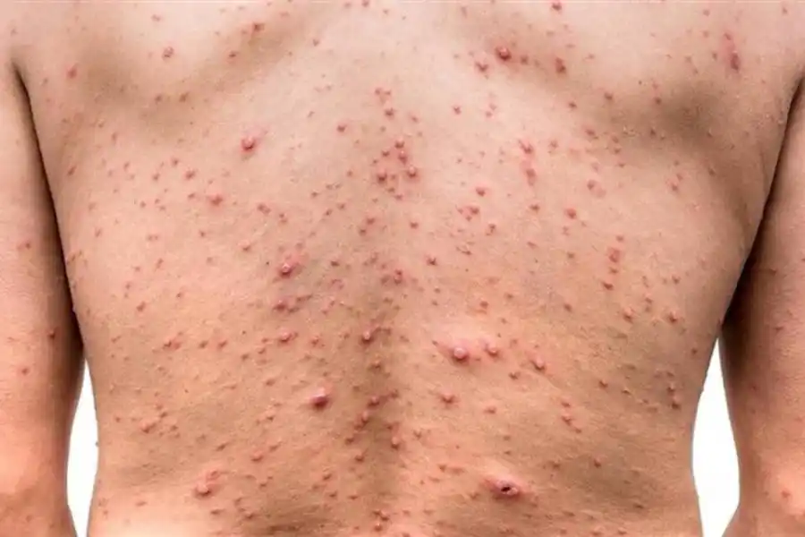 La OMS lleva tranquilidad y aclara que "la viruela del mono no es el nuevo Covid"