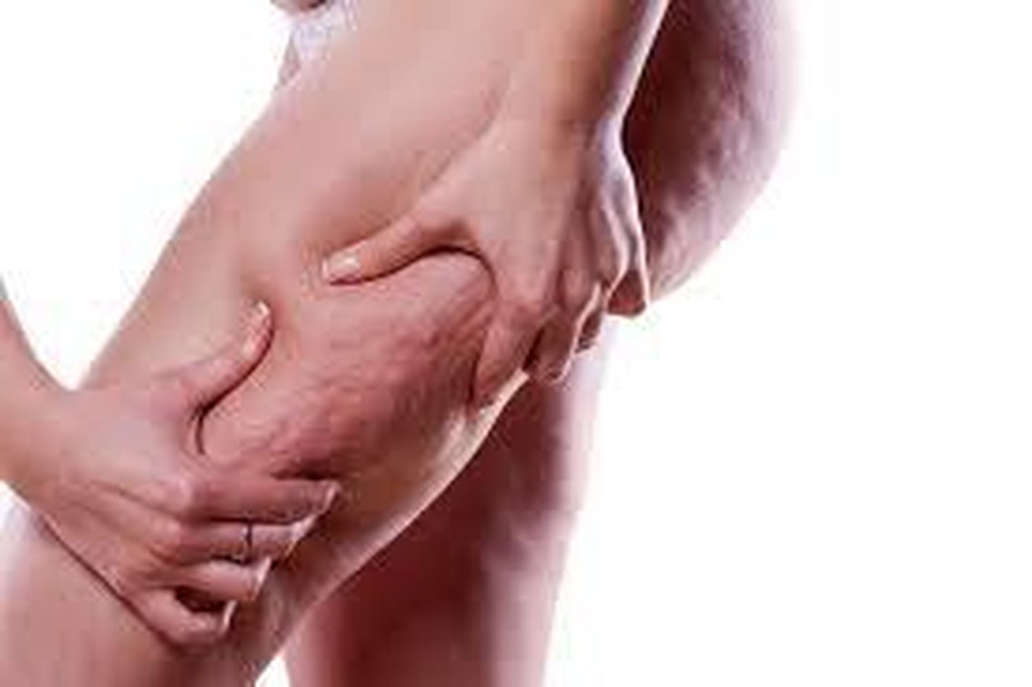 Celulitis: