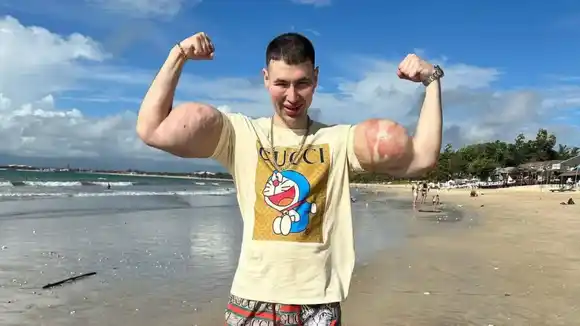La obsesión del “Popeye ruso” por unos bíceps gigantes podría costarle los brazos si no mejora su salud