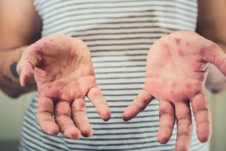 Investigan posible caso de sarampión: instan a vacunarse