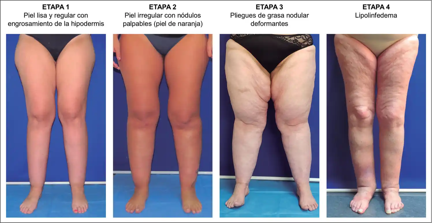 ¿Qué es el Lipedema?