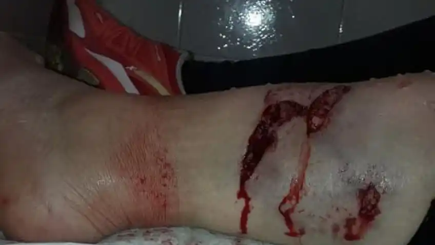 Karina Mujica fue atacada por un perro callejero