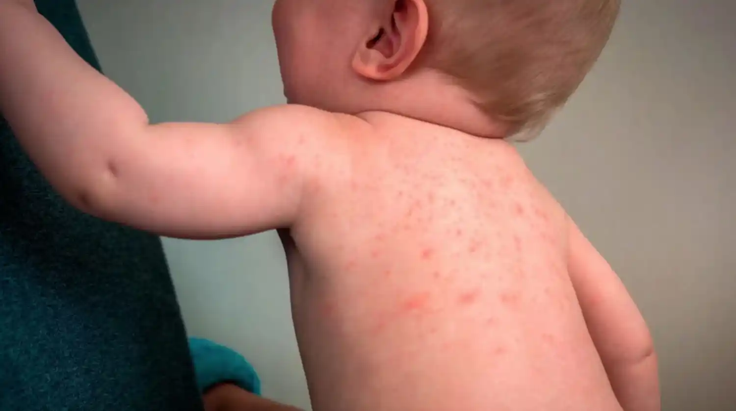 Brote de Sarampión: Zárate vacuna las 24 horas 