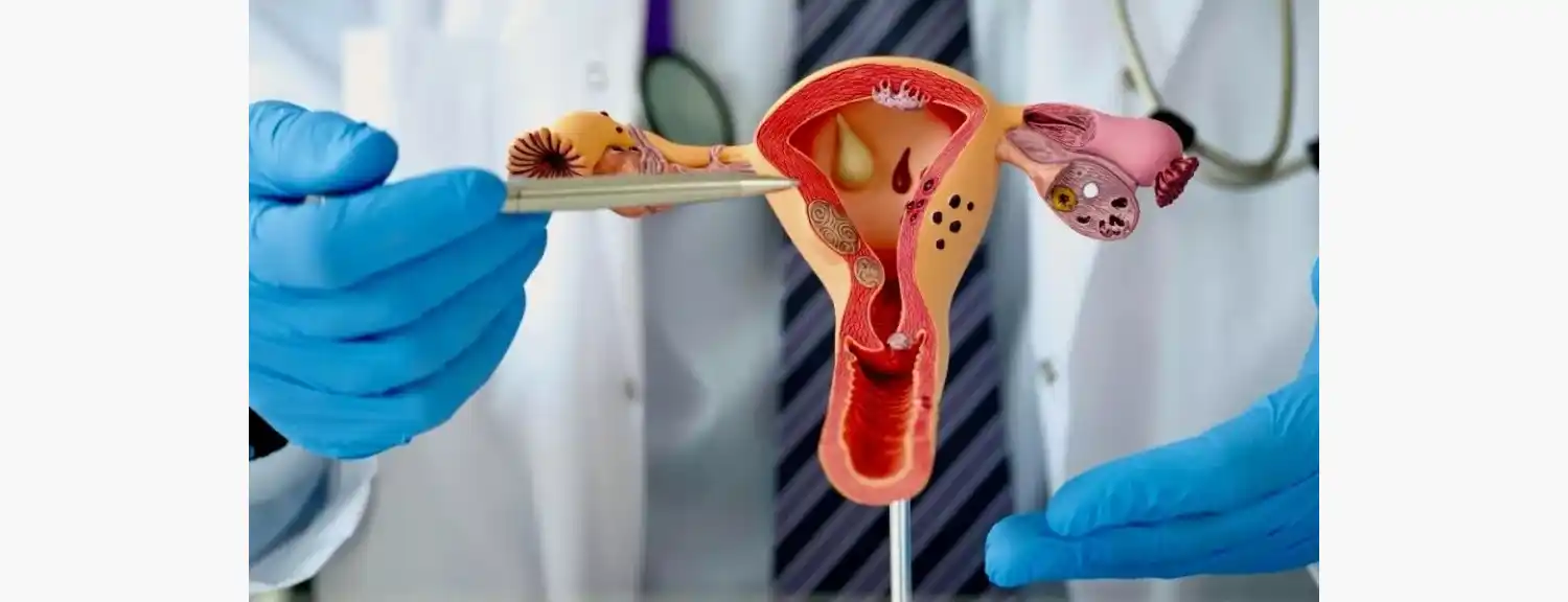 La endometriosis es una patología ginecológica que afecta entre el 10% y el 15% de las mujeres en edad reproductiva.