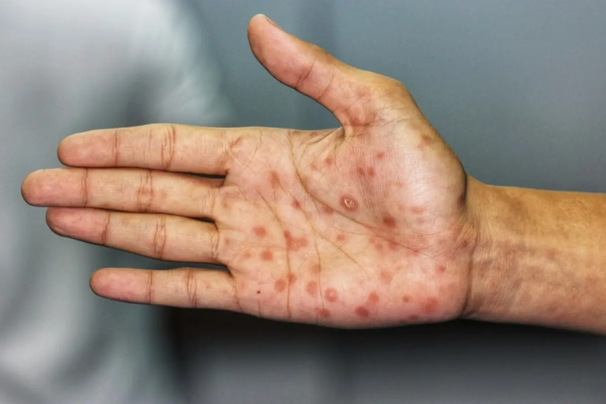 Alarma sanitaria en Argentina: aumentaron los casos de sífilis, especialmente entre adolescentes y jóvenes