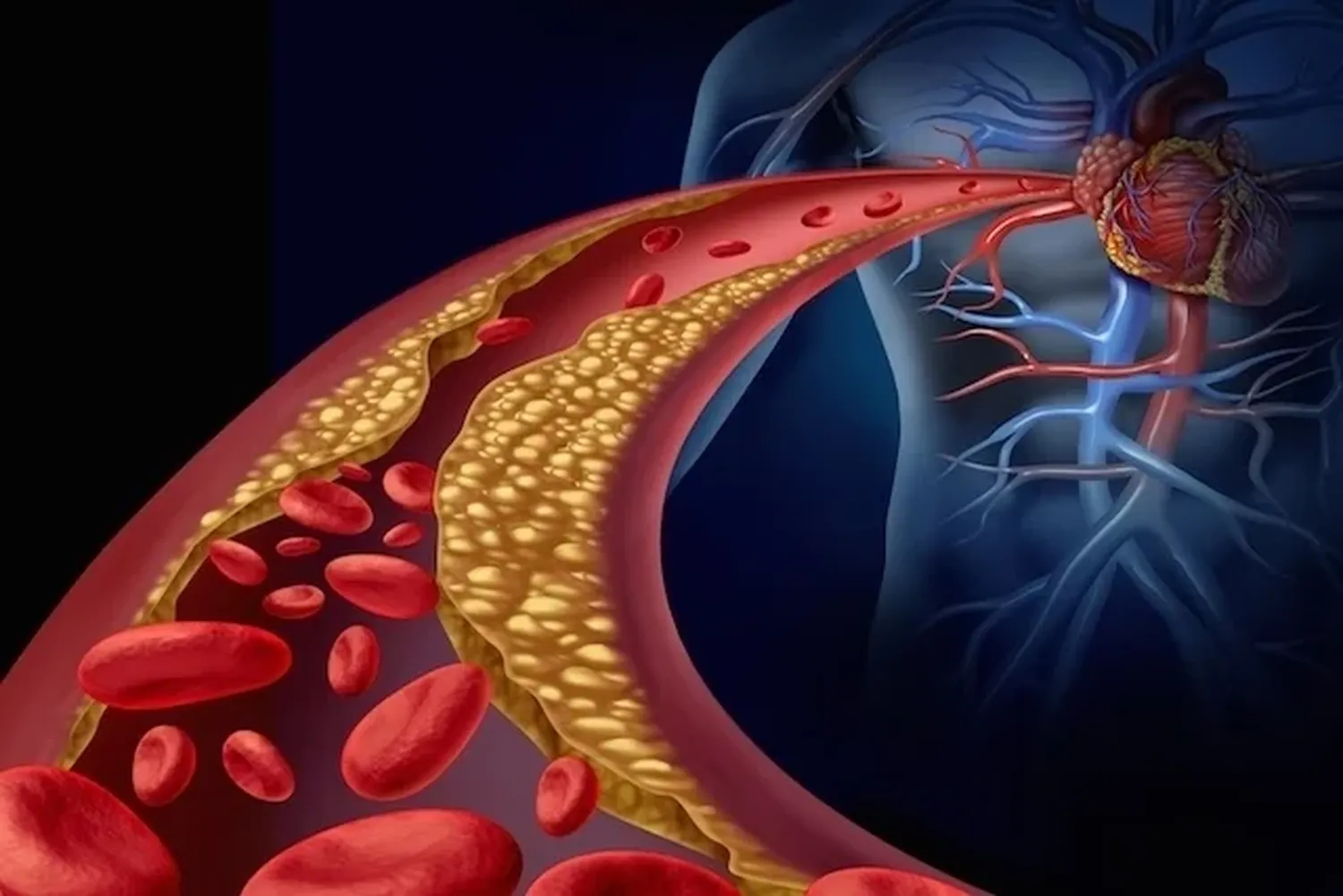 ¿Qué es la aterosclerosis?