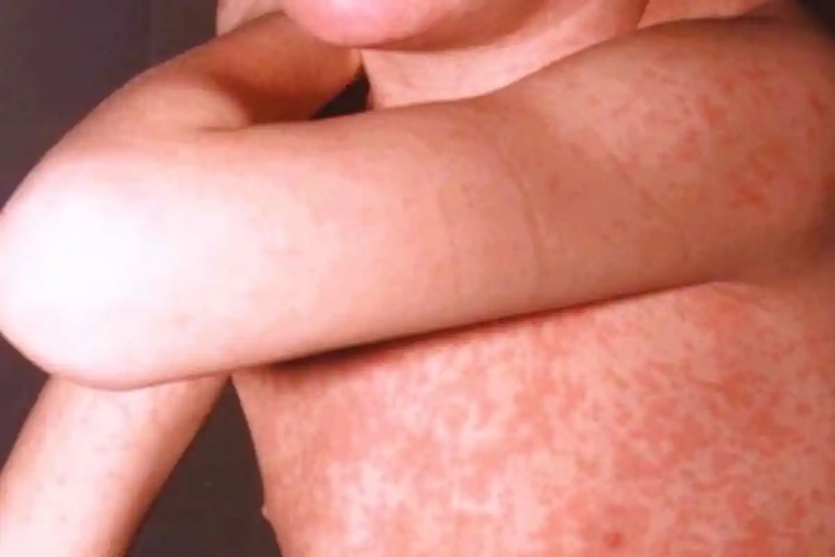 La región perdió el año pasado su estatus de zona libre de la enfermedad debido a un brote en Canadá que las autoridades no pudieron contener en la ventana epidemiológica de un año.