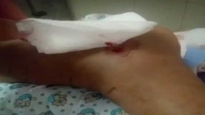 EL SEGUNDO CASO EN UNA SEMANA: niña mordida por una mapanare en Trujillo urge por suero antiofídico