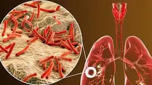 tuberculosis