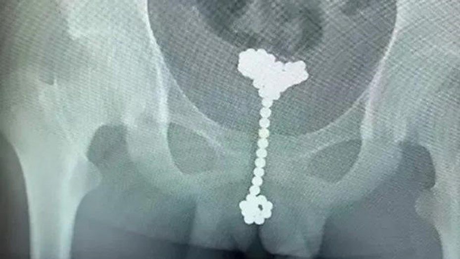 Un nene se metió 31 bolas magnéticas en el pene para "explorar su cuerpo"