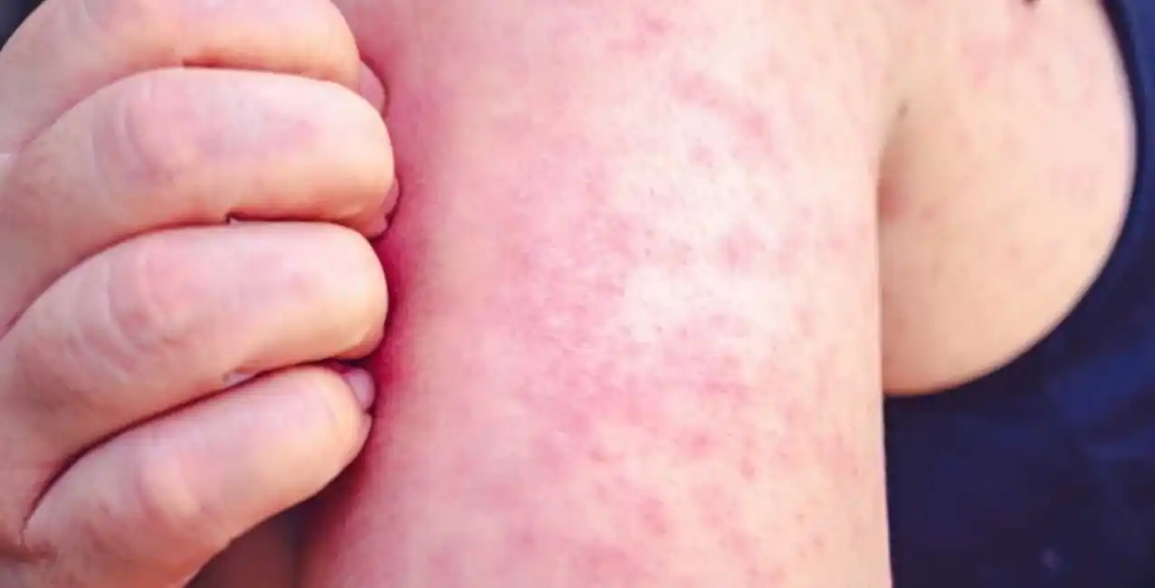 Alerta: detectan sarampión en una embarazada que volvió de las Islas Maldivas