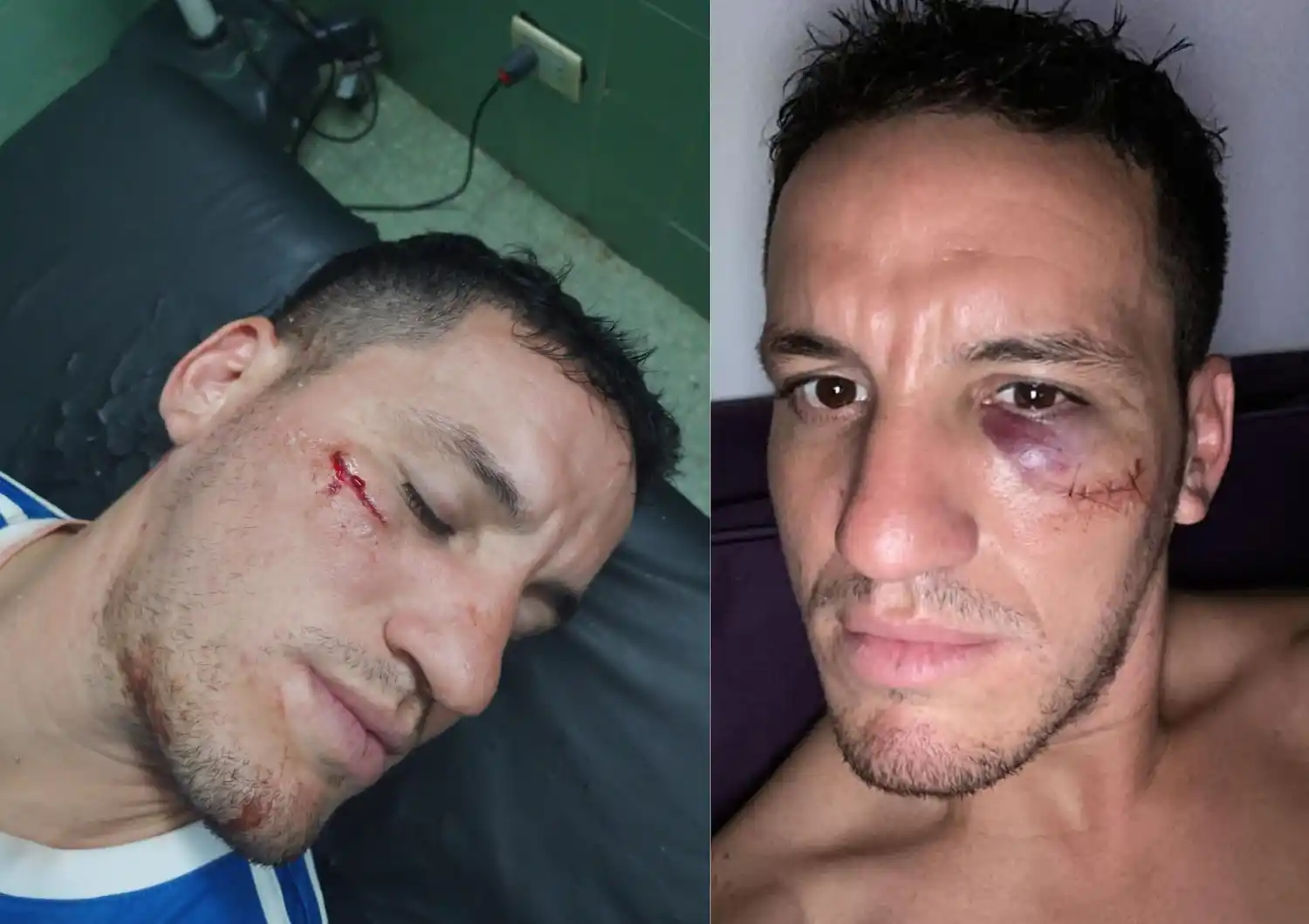 Violencia en la Copa Gualeguaychú: un jugador terminó en el Hospital, con 4 puntos de sutura