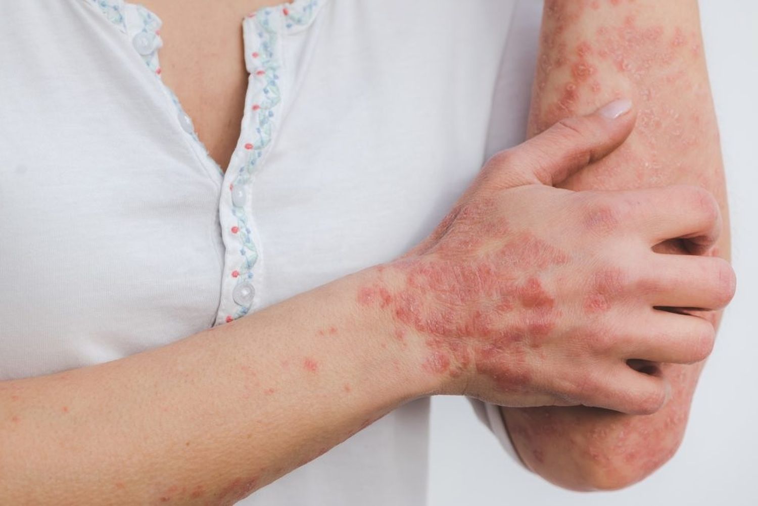 La psoriasis es una de las más de 100 enfermedades autoinmunes detectada.