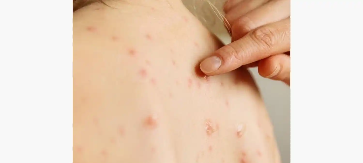 Ya se confirmaron 32 contagios, todos vinculados a brotes con circulación comunitaria.