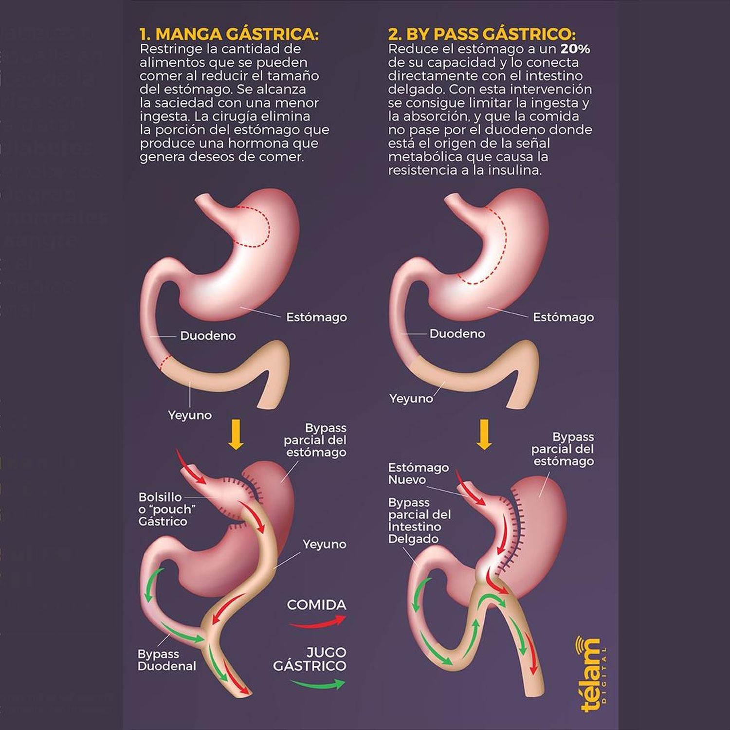 cirugia para la diabetes