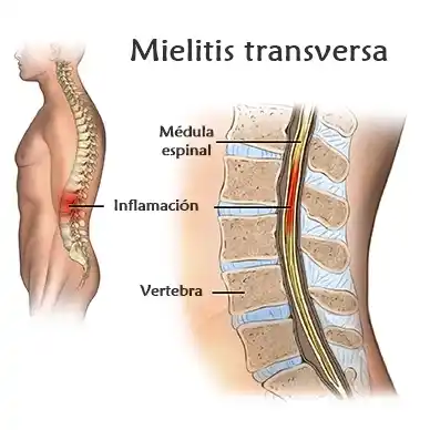 Sentencia histórica: reconocen daño neurológico por la vacuna del COVID-19 de Pfizer