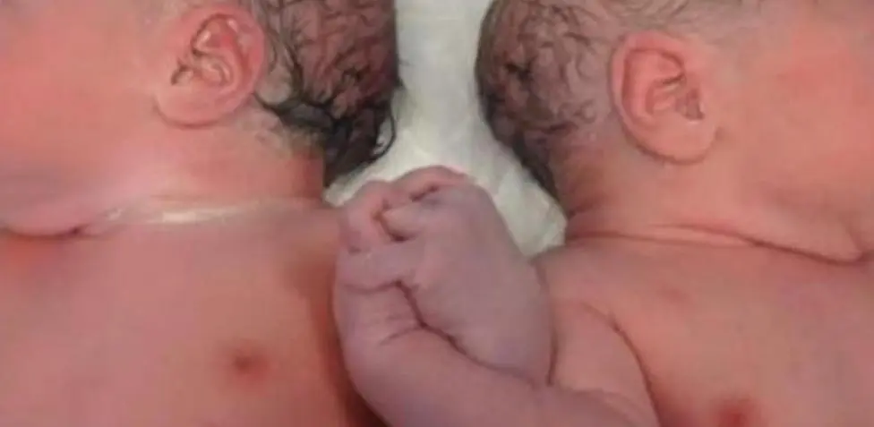 Mujer tuvo gemelos que nacieron en años distintos