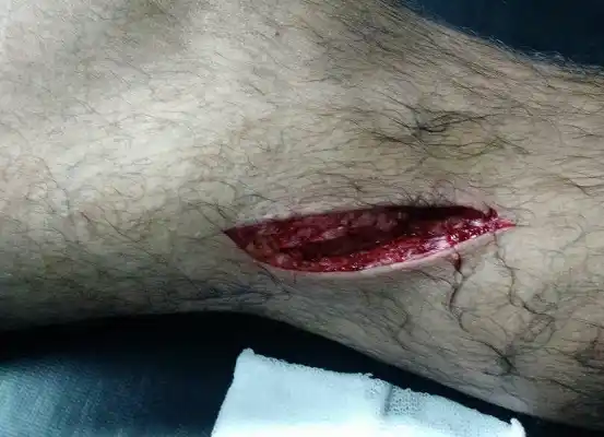 Tras la herida de un operario pidieron mayor responsabilidad en la separación de residuos