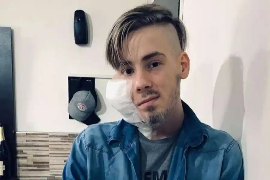 Murió Sebastián Amurín, el joven que tenía un tumor en la cara y conmovió por su lucha a través de las redes sociales