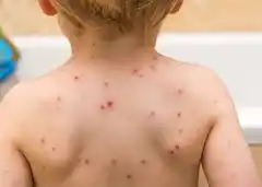 En Tandil se han notificado 13 casos sospechosos de contagio de sarampión