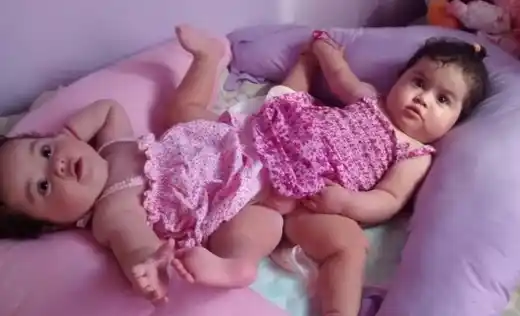 Médicos lograron separar a las siamesas Luciana y Bianca exitosamente 