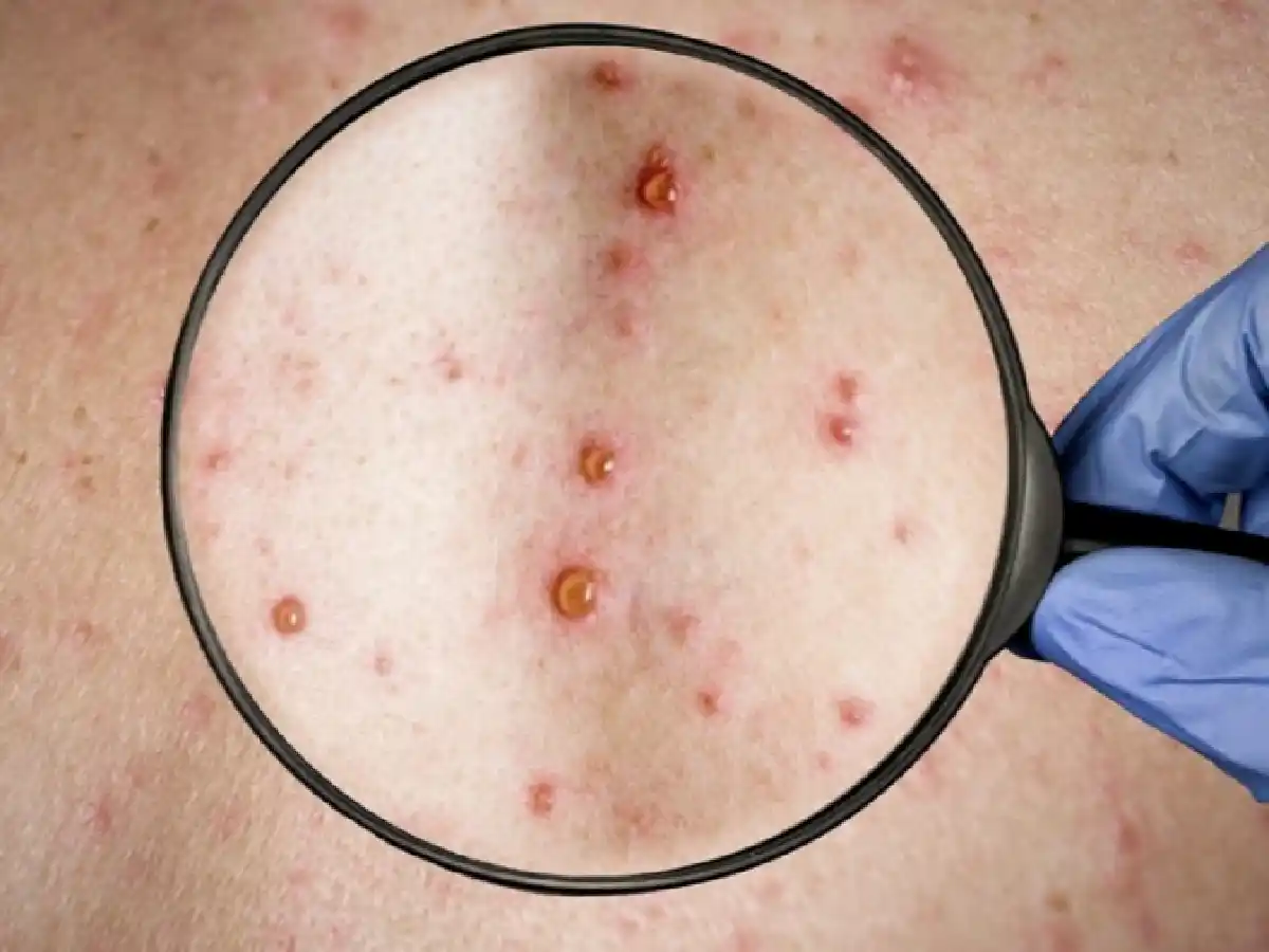 Confirmaron el primer caso de viruela del mono en Tucumán