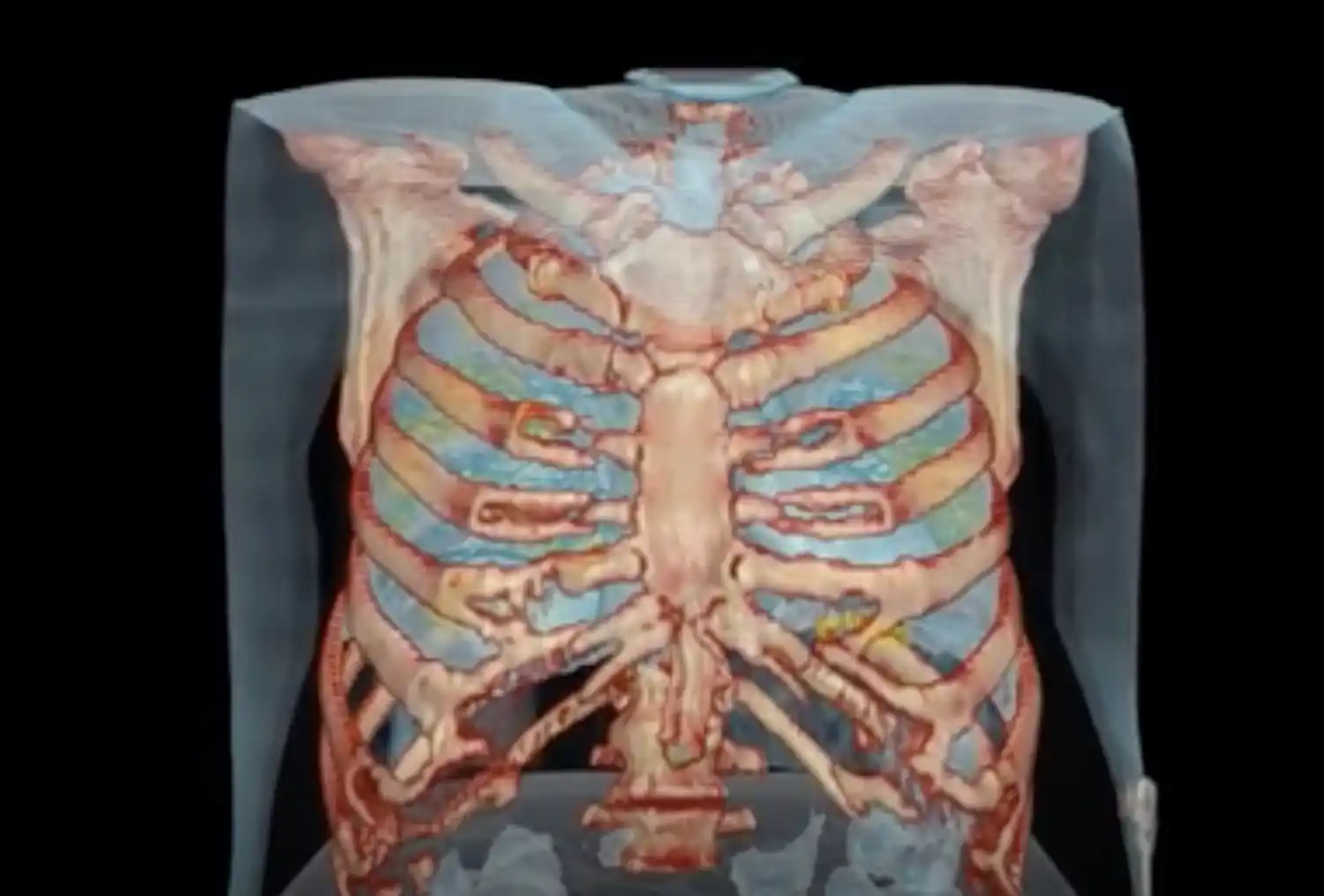 Conoce cómo actúa el coronavirus en los pulmones de un enfermo grave
