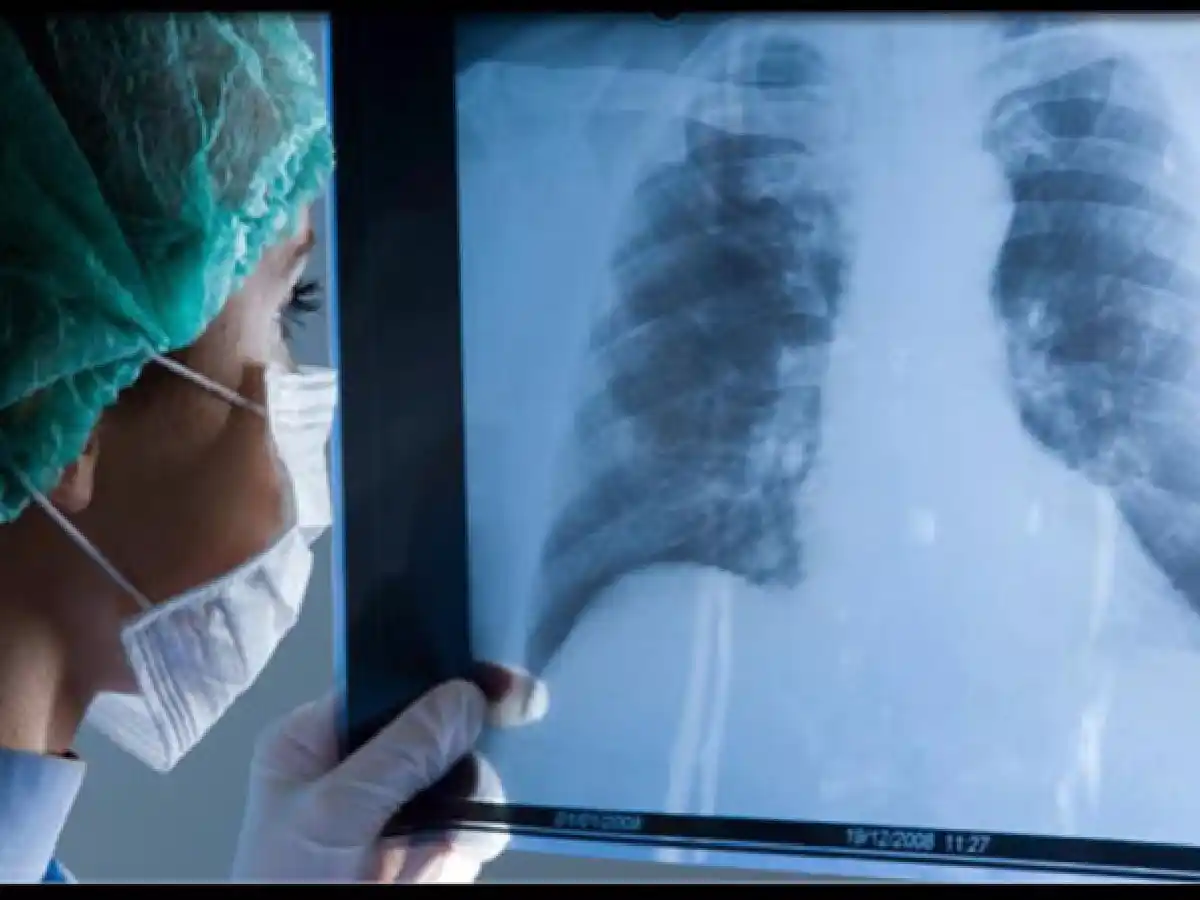 Logran reducir a la mitad riesgo de muerte en tipo más común de cáncer de pulmón 