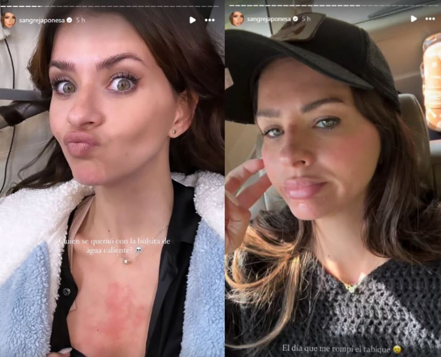 “Me rompí el tabique”: la China Suárez sufrió un accidente en pleno rodaje y mostró cómo le quedó la nariz