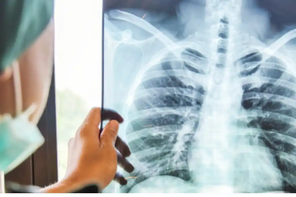 Se observa con preocupación el aumento de casos de tuberculosis