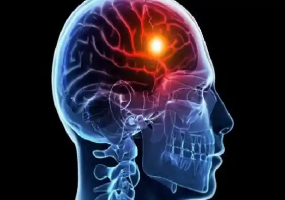 Día mundial del Accidente Cerebro Vascular (ACV), conocé cómo prevenirlo