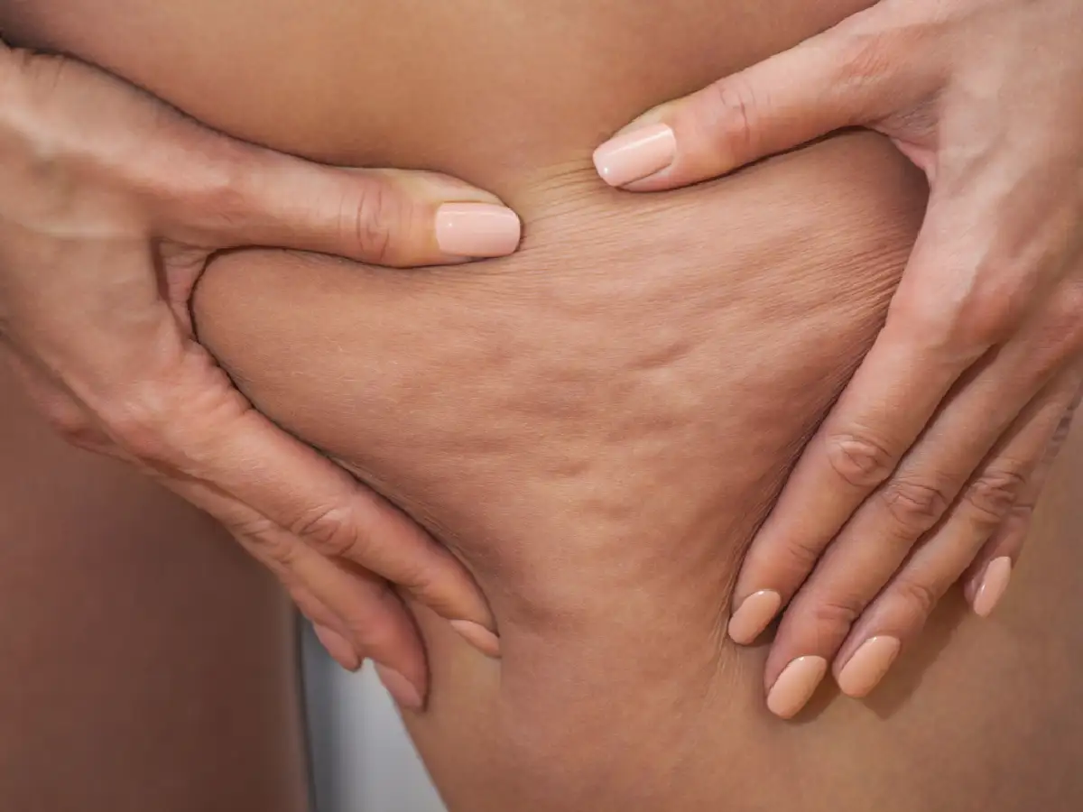 Estudio revela que se puede reducir  la celulitis en un 90% de los pacientes 