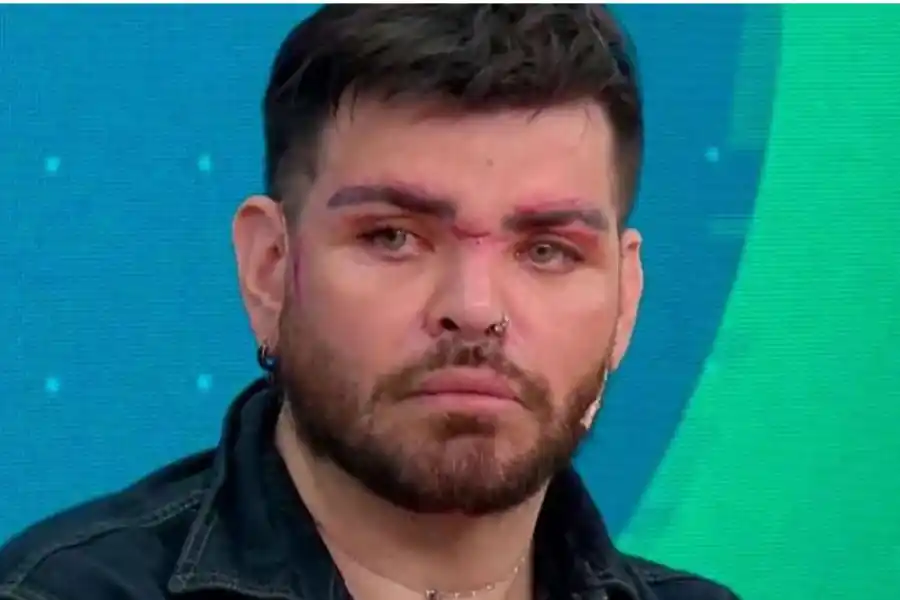 Fran Mariano denunció al cirujano por defigurarle la cara y lo acusó de realizarle prácticas que no había pedido