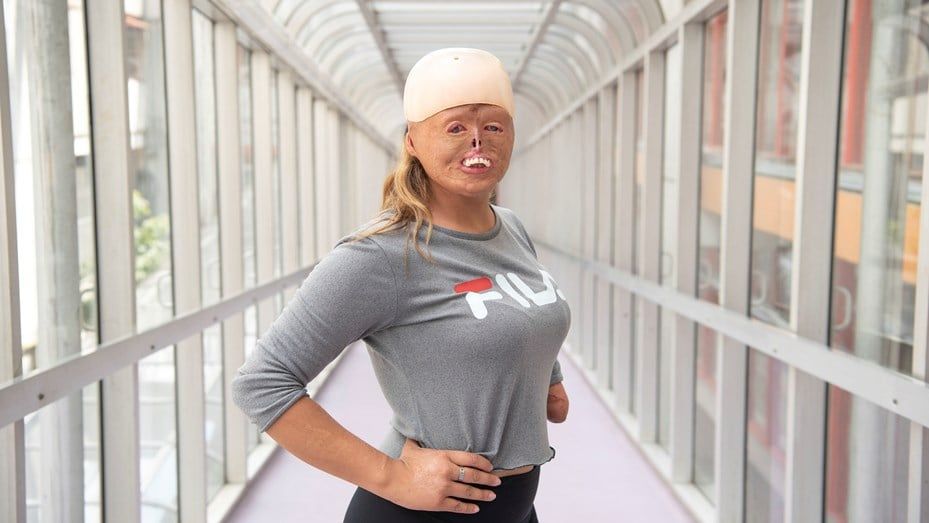 Cuando era bebé se quemó el 90% de su cuerpo y hoy es deportista y modelo