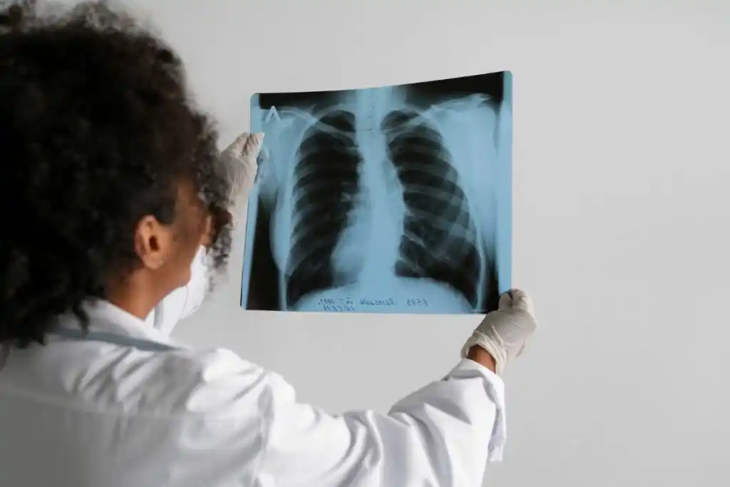 Los casos de tuberculosis aumentaron considerablemente entre 2020 y 2025
