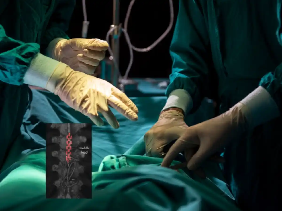 Una mujer logró volver a caminar gracias a un implante espinal