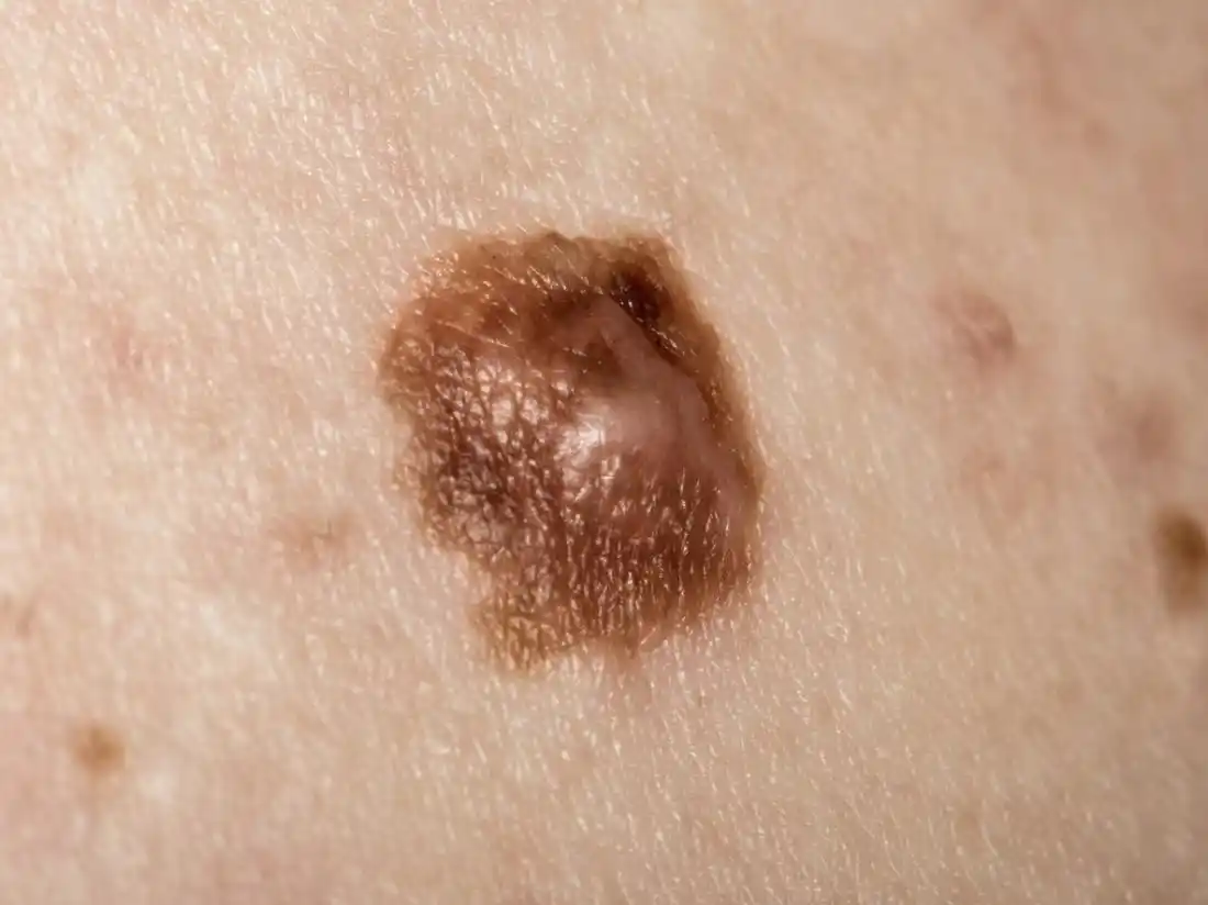 En promedio mueren más de 10 argentinos por semana  a causa del melanoma