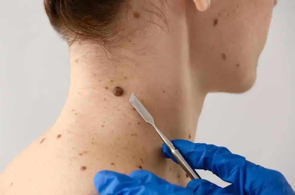 Formosa se suma esta semana a la Campaña nacional de prevención del cáncer de piel