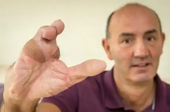 Usaron los dedos de los pies para reemplazarle los que perdió en la mano