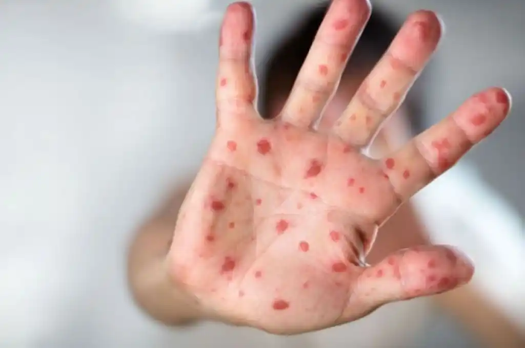 Argentina controló el brote de sarampión y es territorio libre de la enfermedad