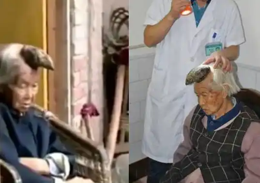 Operarán a "mujer unicornio" para quitarle su cuerno de la cabeza