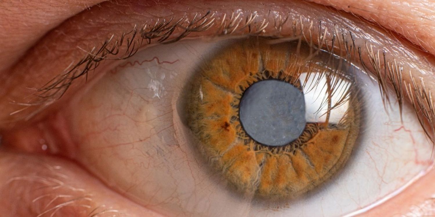 Qué es el glaucoma